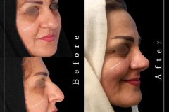 جراحی-بینی-116