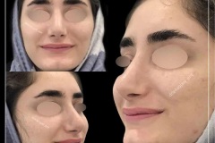 جراحی-بینی-57