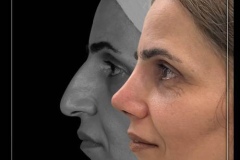 1_rhinoplasty-168