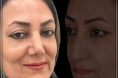 جراحی-بینی-143