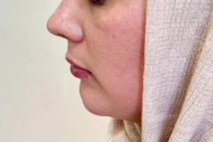 جراحی-بینی-152