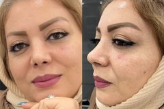 hinoplasty-127