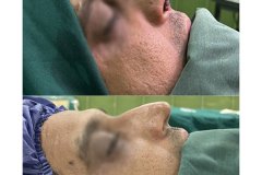hinoplasty-129