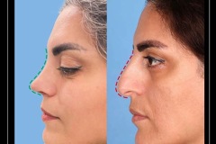 rhinoplasty-158