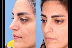 rhinoplasty-159