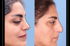 rhinoplasty-160