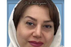 rhinoplasty-166-1