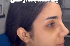 rhinoplasty-170