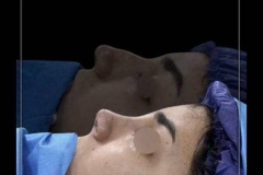 rhinoplasty-172-1