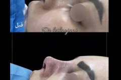 rhinoplasty-171