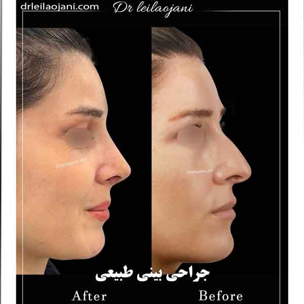 عکس جراحی بینی طبیعی