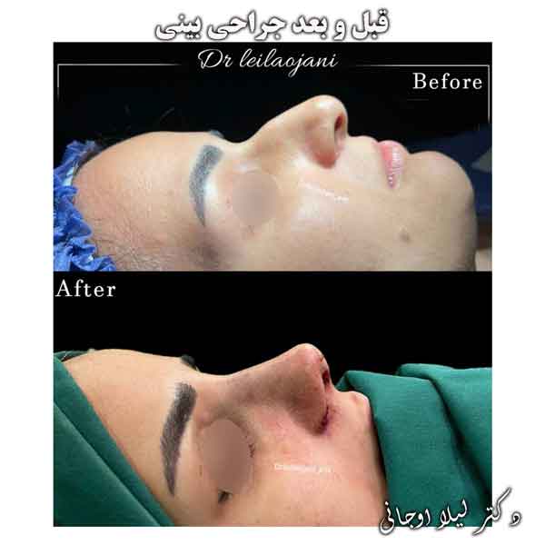 عکس قبل و بعد جراحی بینی _ بهترین جراح بینی چالوس