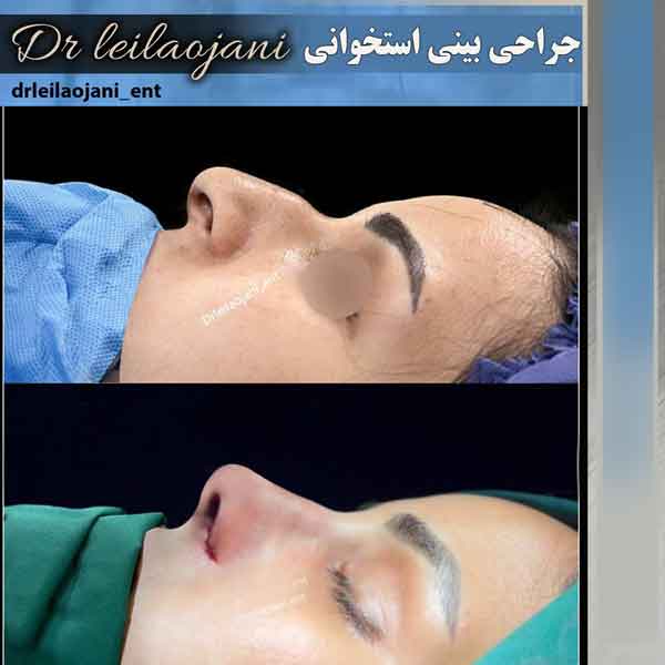 عکس جراحی بینی استخوانی