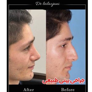 جراحی بینی طبیعی - دکتر لیلا اوجانی