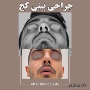 جراحی بینی کج