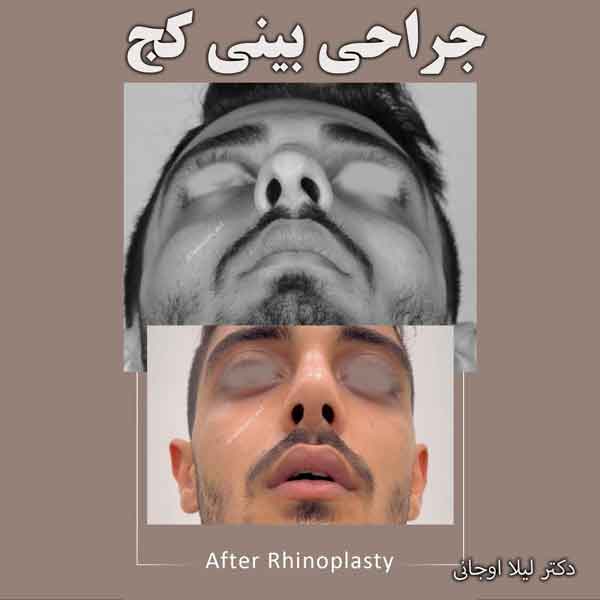 عکس جراحی بینی کج