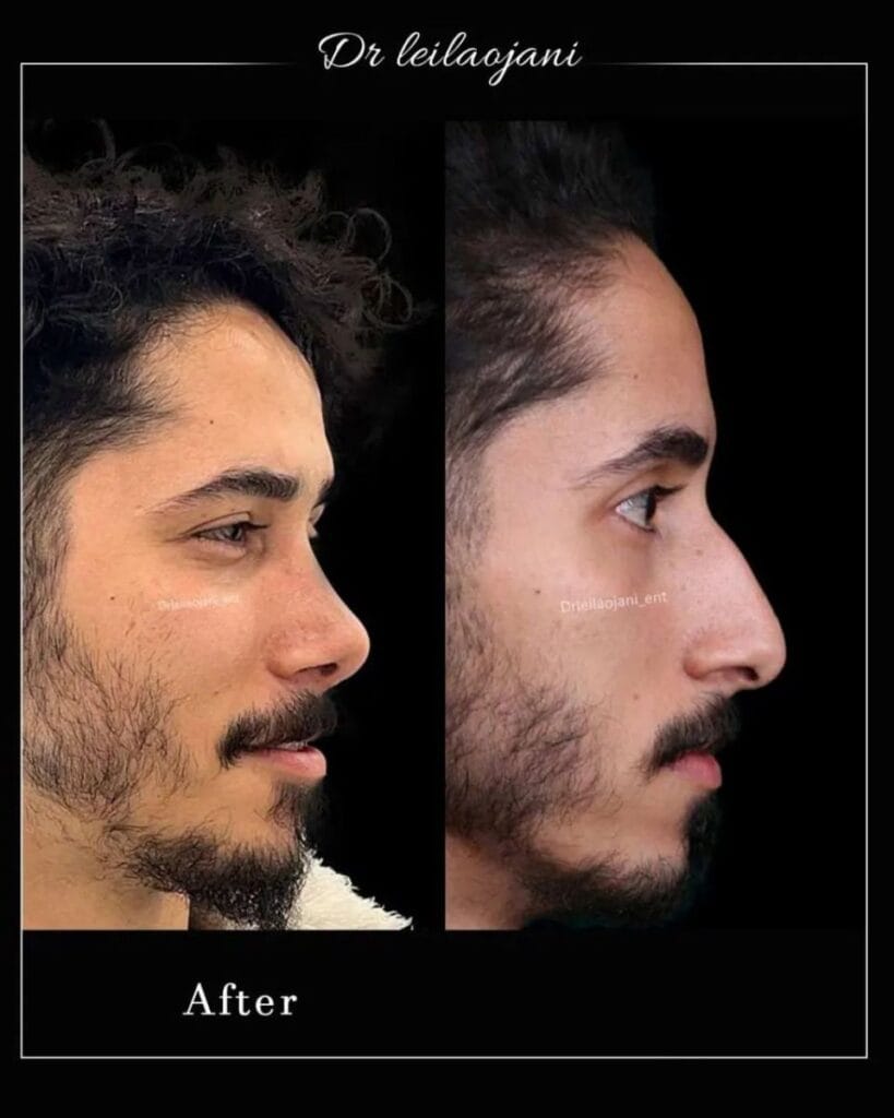 جراحی بینی استخوانی در چالوس - دکتر لیلا اوجانی