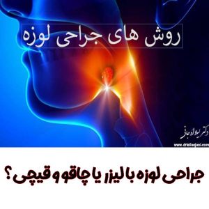 روش های جراحی لوزه - دکتر لیلا اوجانی