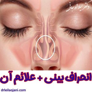 عکس انحراف بینی + علائم آن - دکتر لیلا اوجانی