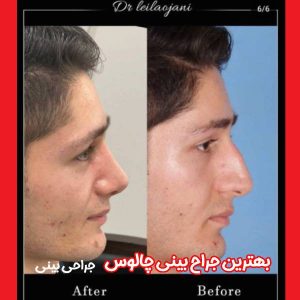 عکس نمونه کار جراحی بینی - بهترین جراح بینی چالوس - دکتر لیلا اوجانی