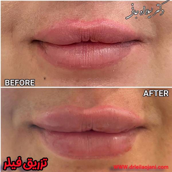 عکس قبل و بعد تزریق فیلر