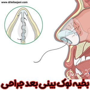 عکس بخیه نوک بینی بعد جراحی