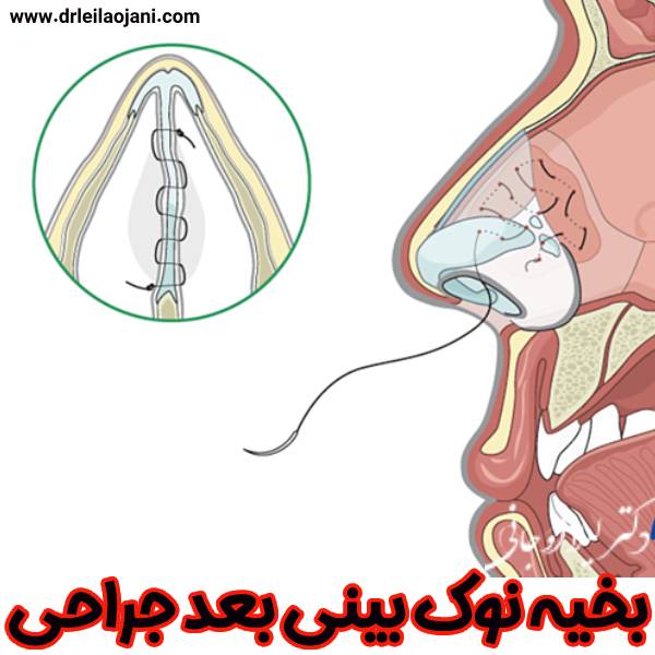عکس بخیه نوک بینی بعد جراحی - دکتر لیلا اوجانی