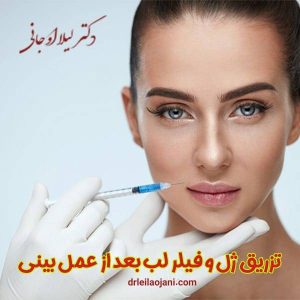 تزریق فیلر بعد عمل بینی