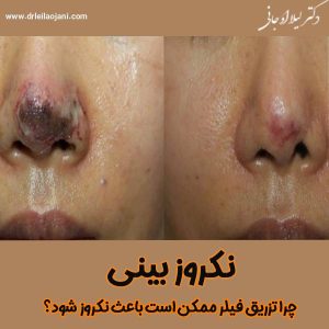 نکروز بینی