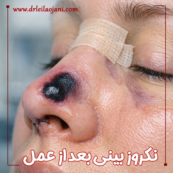 نکروز بینی بعد از عمل + دکتر لیلا اوجانی