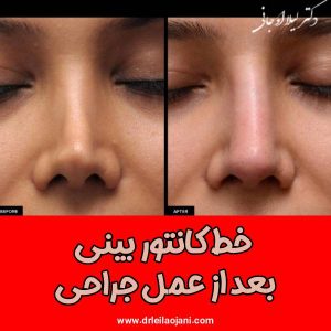 خط کانتور بینی بعد از عمل جراحی - دکتر لیلا اوجانی