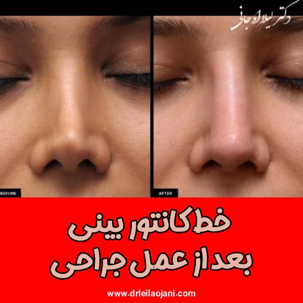 خط کانتور بینی بعد از عمل جراحی - دکتر لیلا اوجانی