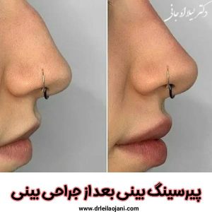 پیرسینگ بعد از جراحی بینی - دکتر لیلا اوجانی