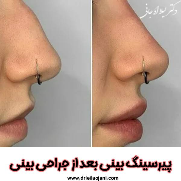 پیرسینگ بعد از جراحی بینی - دکتر لیلا اوجانی