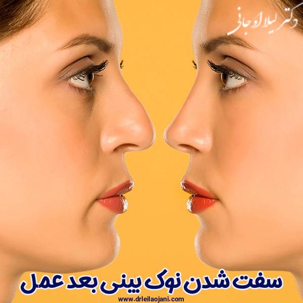 سفت شدن نوک بینی بعد عمل - دکتر لیلا اوجانی