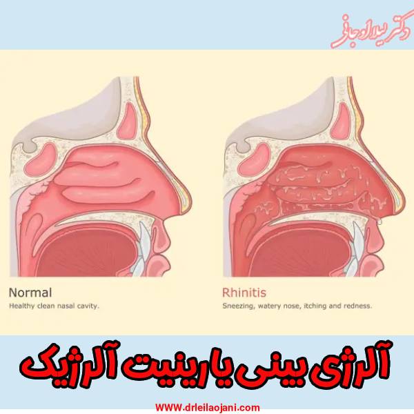 رینیت آلرژیک - دکتر لیلا اوجانی