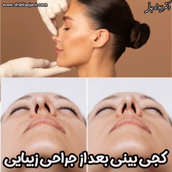 کجی بینی بعد عمل زیبایی - دکتر لیلا اوجانی