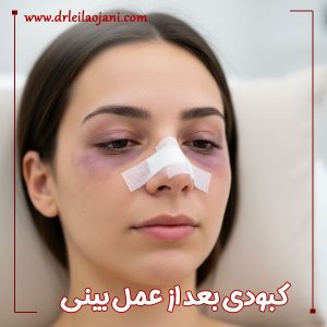 کبودی بعد از عمل بینی + دکتر لیلا اوجانی