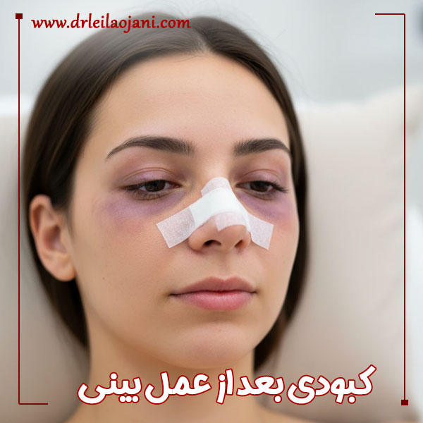 کبودی بعد از عمل بینی + دکتر لیلا اوجانی